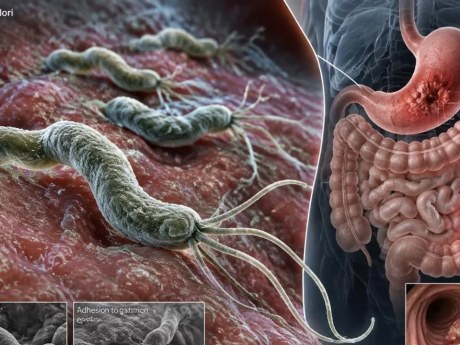 Исследование связало Helicobacter pylori с риском рака кишечника